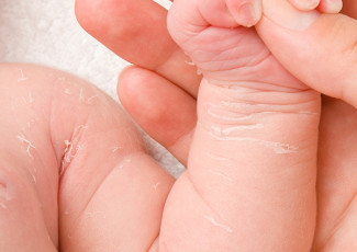 <h3>Promene na koži kod dece- saveti za lečenje i prevenciju</h3>
