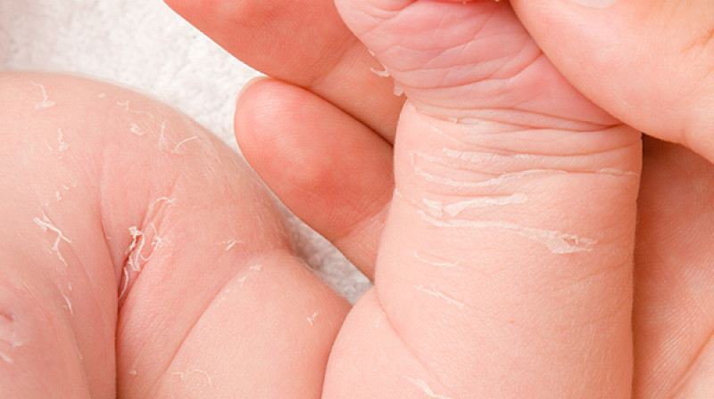 Promene na koži kod dece- saveti za lečenje i prevenciju