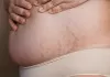 Dijastaza nakon porođaja - najbolje vežbe i kako je se rešiti