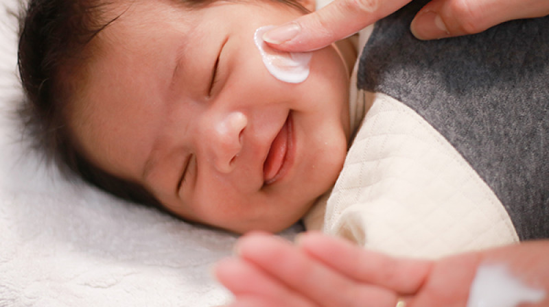 Alergija kod beba: Koje su najčešće i kako da ih prepoznate?